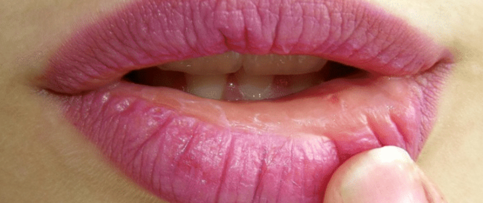 lèvres gercées